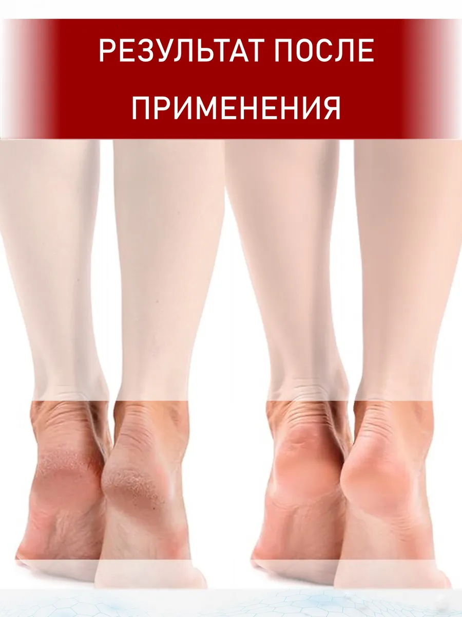 Крем с мочевиной 35 + ионы серебра 170 мл